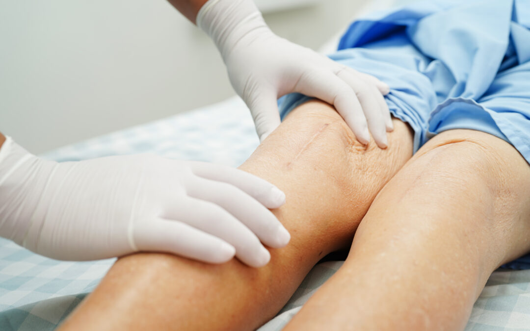 Knee Replacement Outcomes